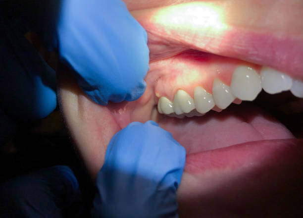 Best Emergency Broken Tooth Repair in Osceola, IN